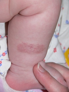 Небольшое пятнышко чаще всего вид гемангиомы у новорожденных